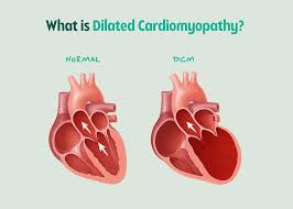Dilated Cardiomyopathy (DCM) In Dogs